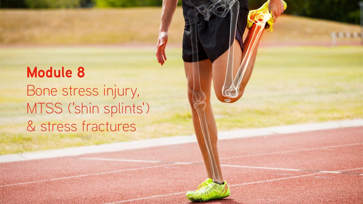 Bone stress injury, 'shin splints' and stress fractures